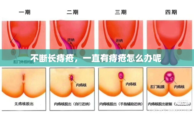 不斷長痔瘡，一直有痔瘡怎么辦呢 