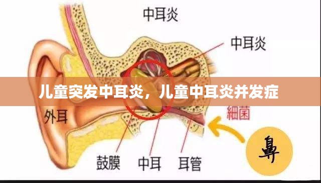 兒童突發(fā)中耳炎，兒童中耳炎并發(fā)癥 